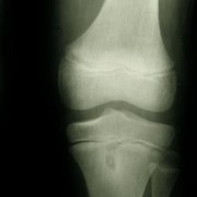 Osteoarthritis related image